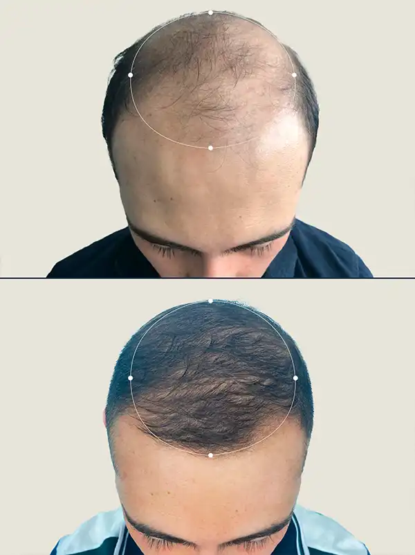 Img-Clinica_Capillare-Antes&Despues-4