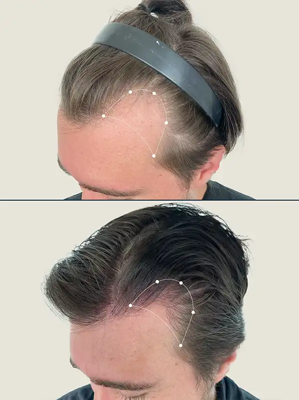 Img-Clinica_Capillare-Antes&Despues-6