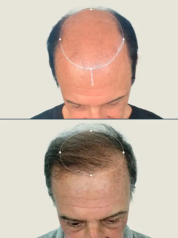 Img-Clinica_Capillare-Antes&Despues-7