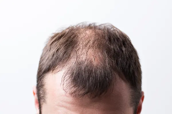 La búsqueda por detener la caída del cabello y recuperar una melena saludable ha impulsado innovaciones constantes. Con la última tecnología para la calvicie, hoy en día es posible acceder...